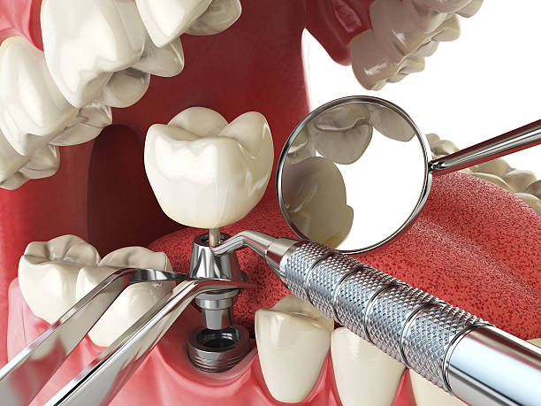 Best Urgent Care for Lost Fillings or Crowns in Laguna Beach, CA